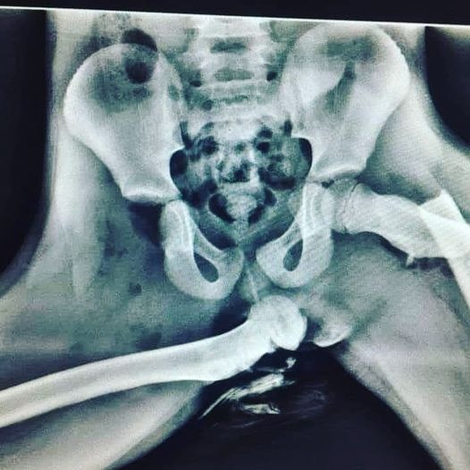 Piedi sul cruscotto...come rimanere invalidi a vita!